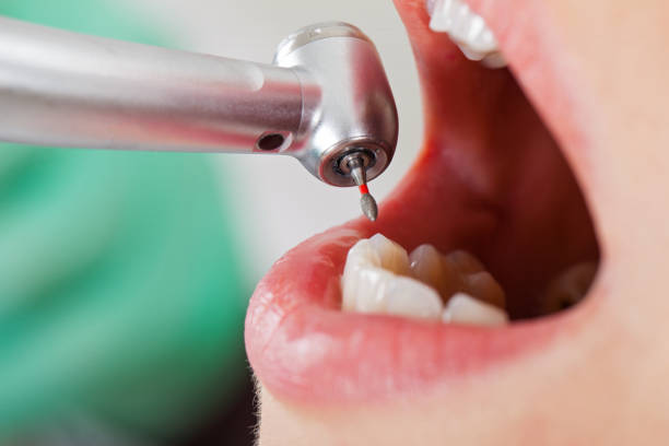 Best Chipped Tooth Repair Near Me  in Berkeley Lake, GA